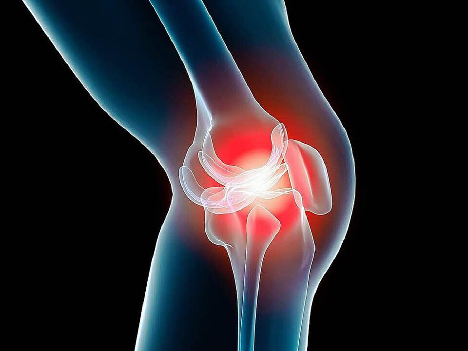 arthrosis of the knee