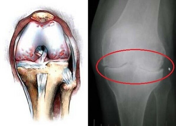 knee osteoarthritis